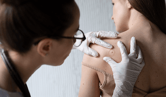 TILs Therapy for Melanoma