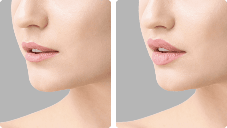 Lip Fillers before and after