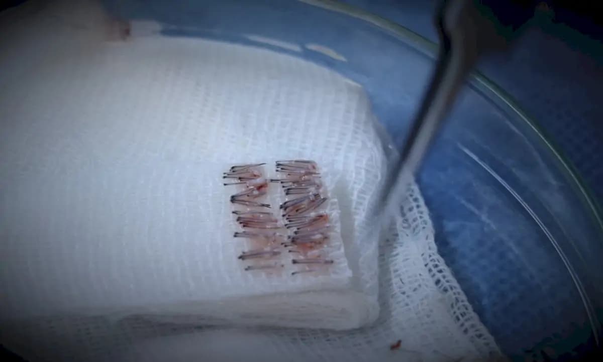 Emphair Hair Transplant Clinic - Image 3