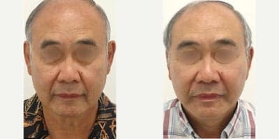55-64 year old man treated with Facelift, MACS Facelift, Buccal Fat Removal