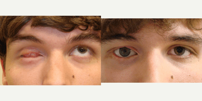 Facial Reconstructive Surgery