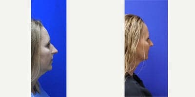 Rhinoplasty