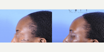 Forehead Reduction