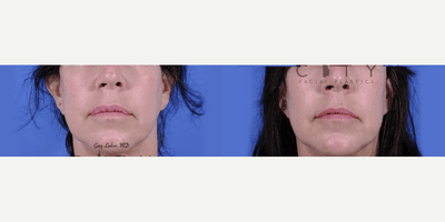 Lip Reduction