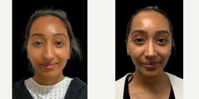 Rhinoplasty