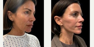 Facelift