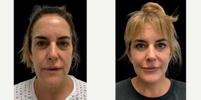 Eyelid Surgery