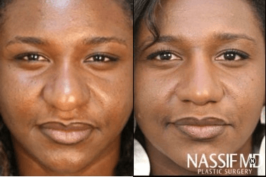 African American Rhinoplasty