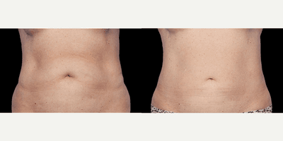 Coolsculpting