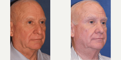 Rhinoplasty