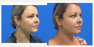 Coolsculpting