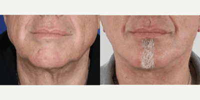 Lower Facelift