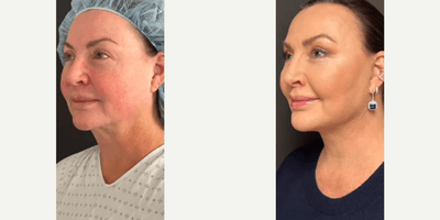 Lip Lift