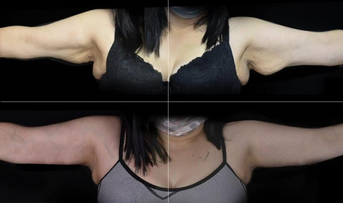 upper arm liposuction