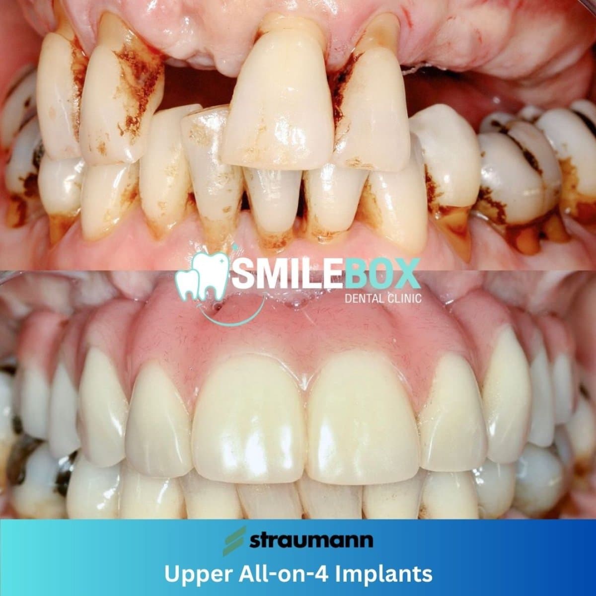 All-on-4 dental implants