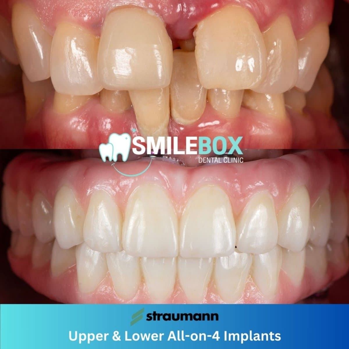 All-on-4 dental implants
