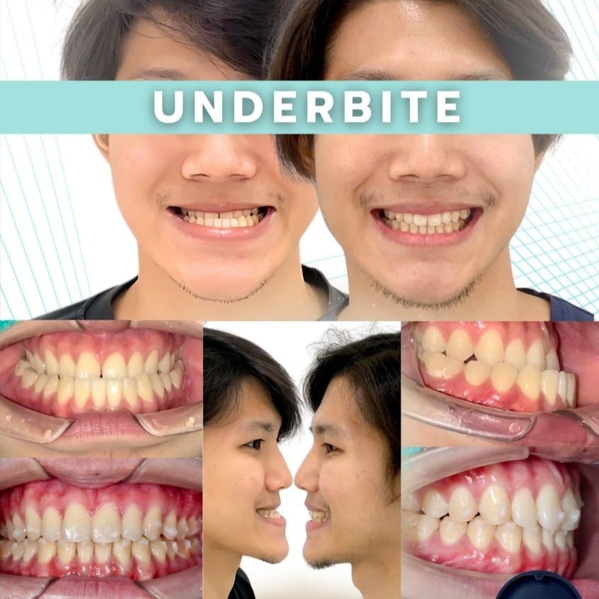 with clear aligners