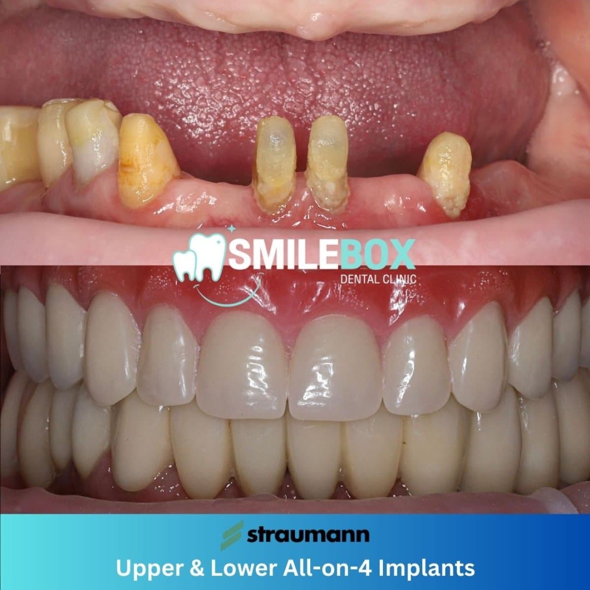 All-on-4 dental implants