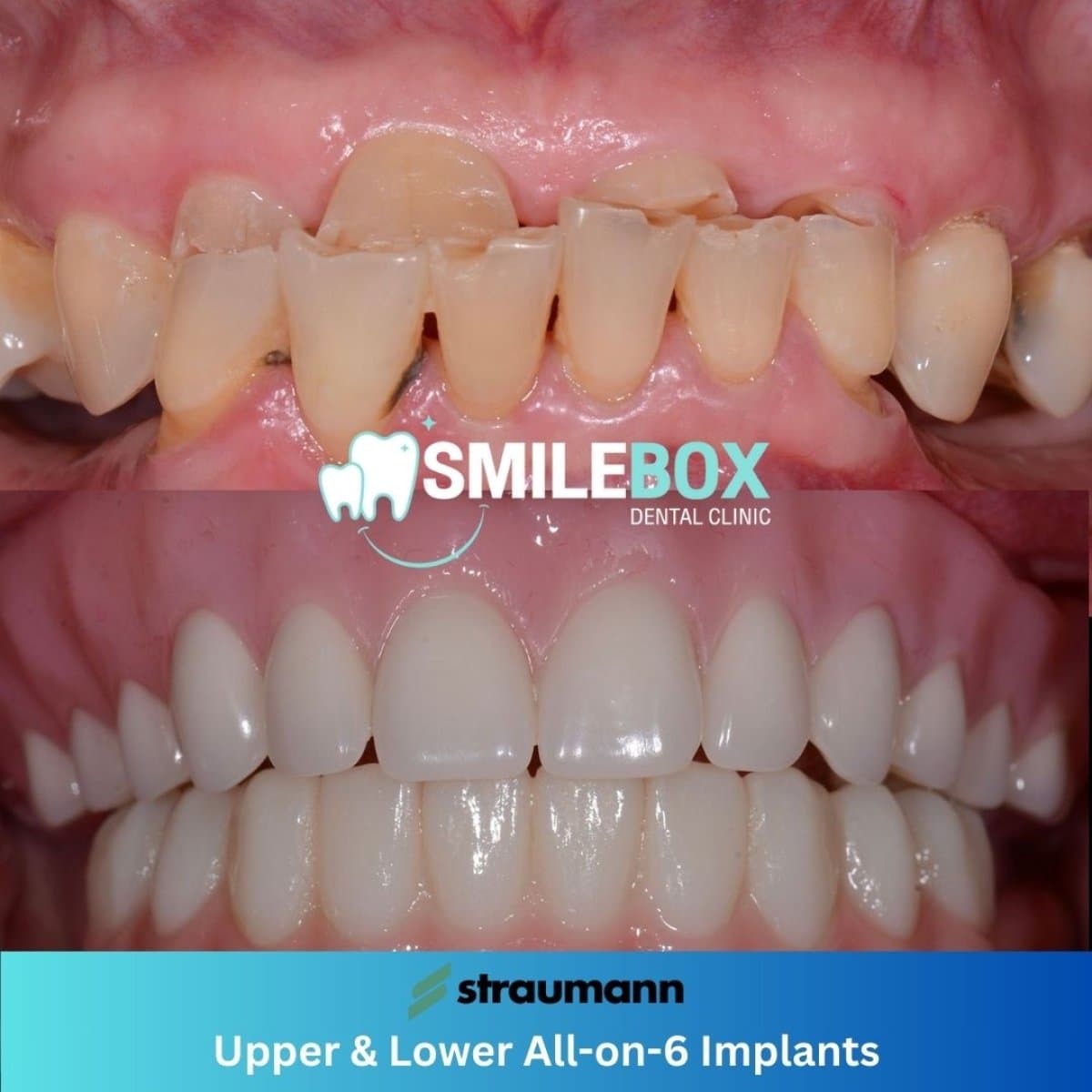 All-on-6 dental implants