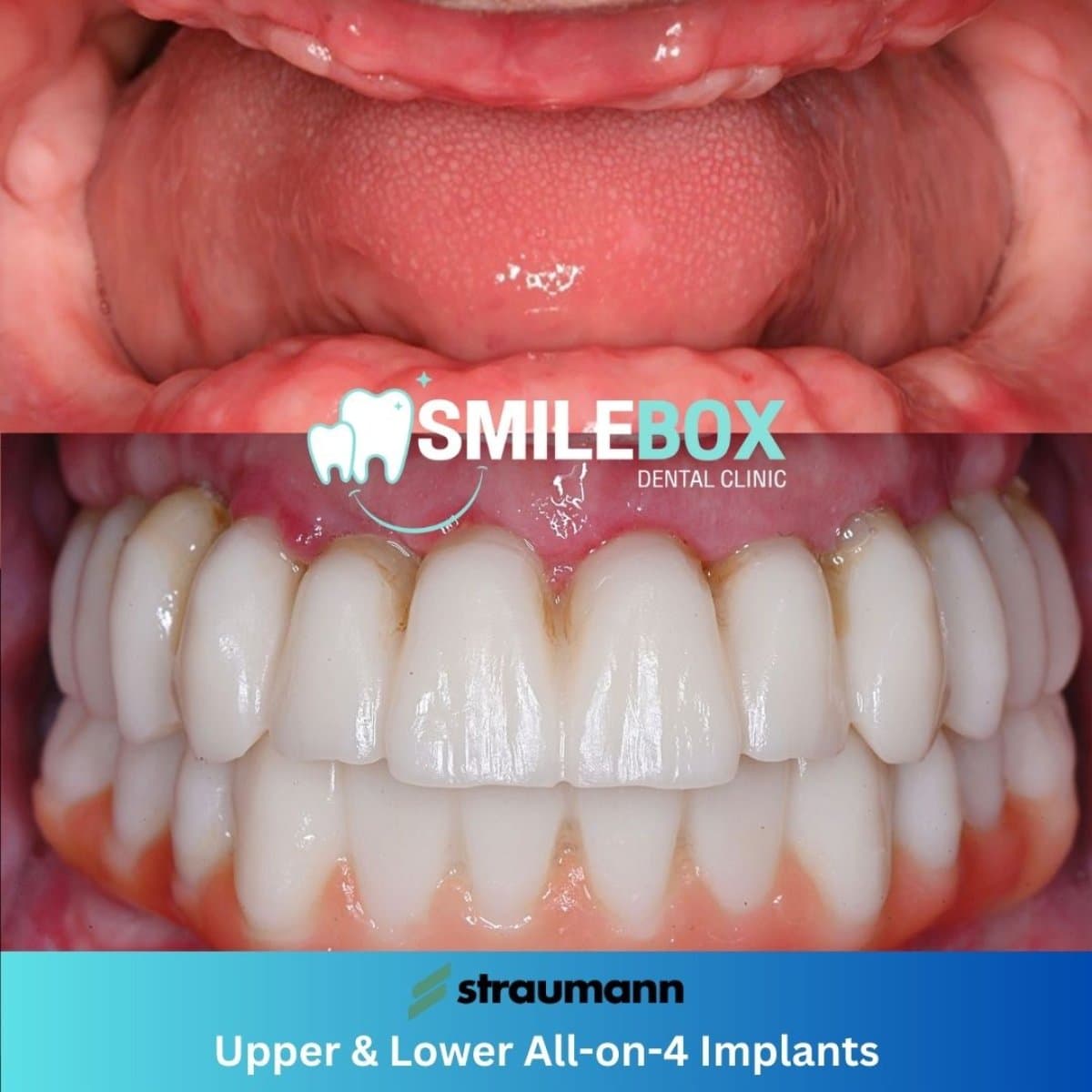 All-on-4 dental implants