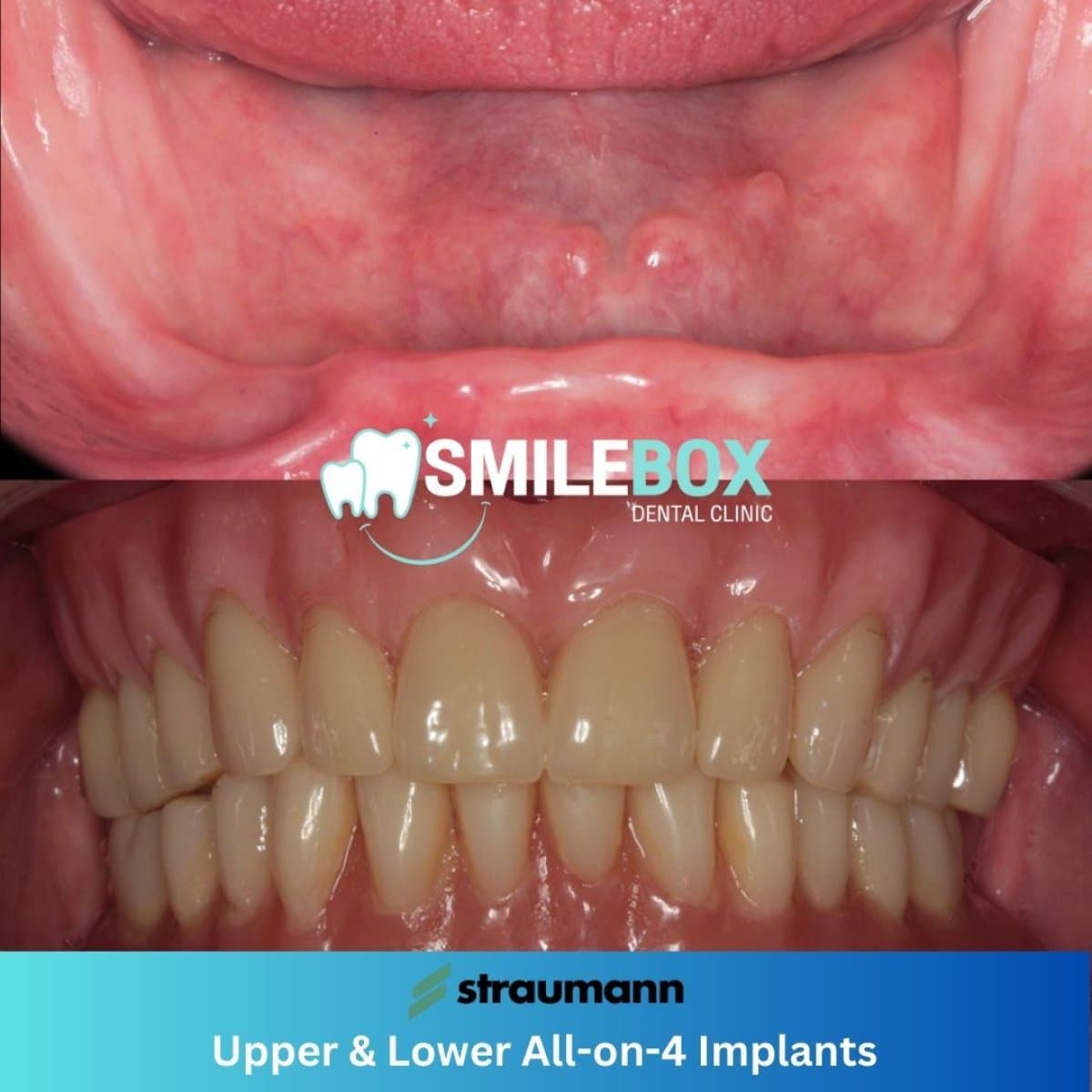 All-on-4 dental implants