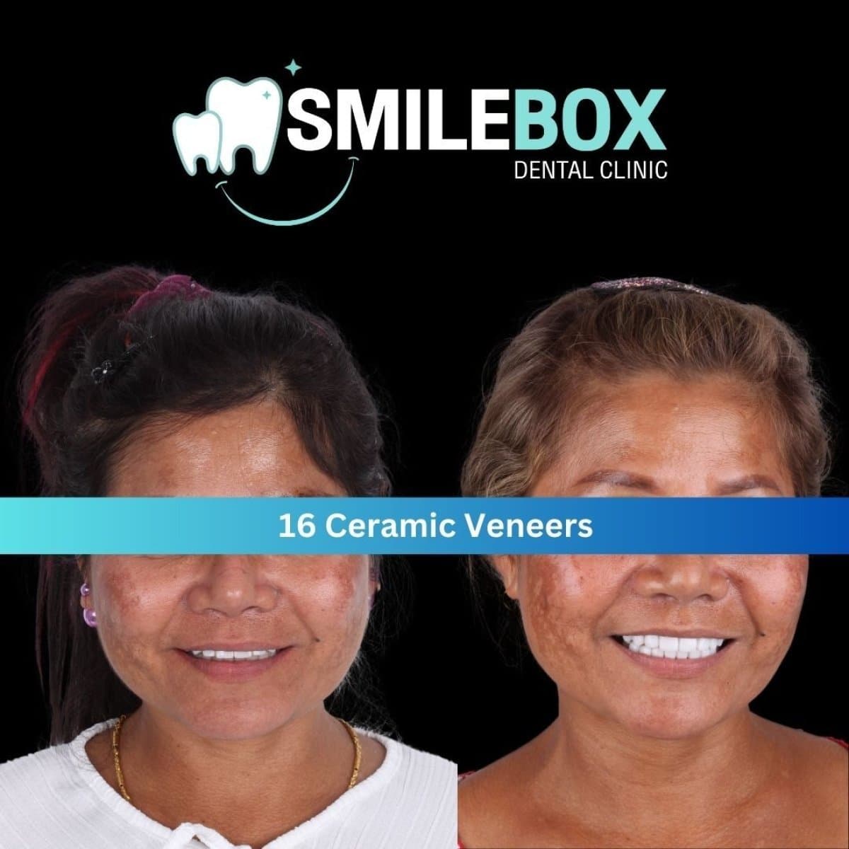 results of 16 ceramic veneers