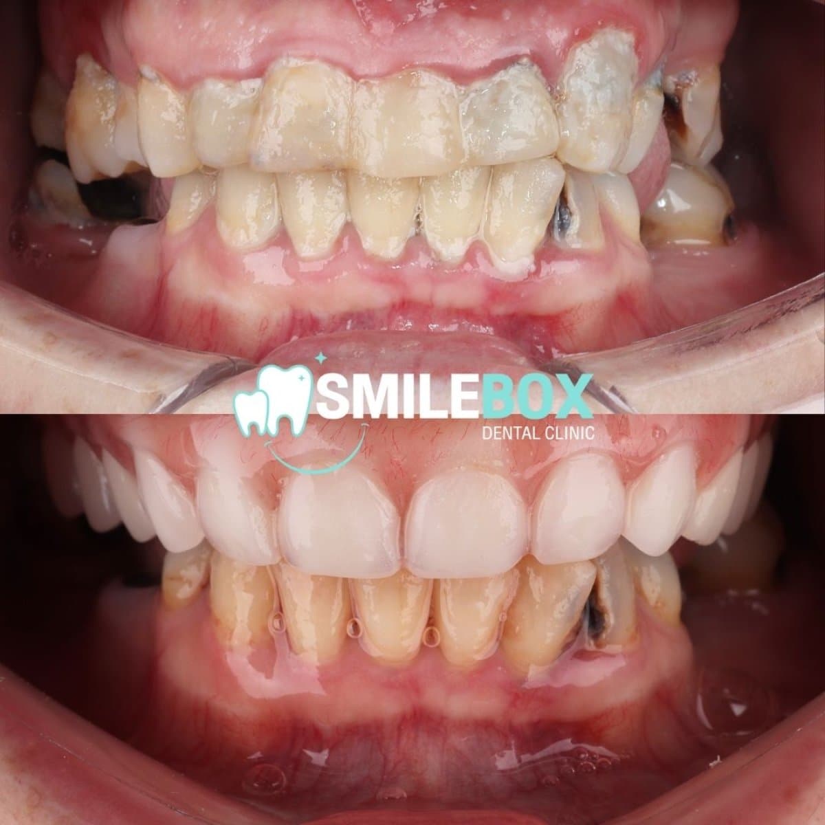 All-on-4 dental implants