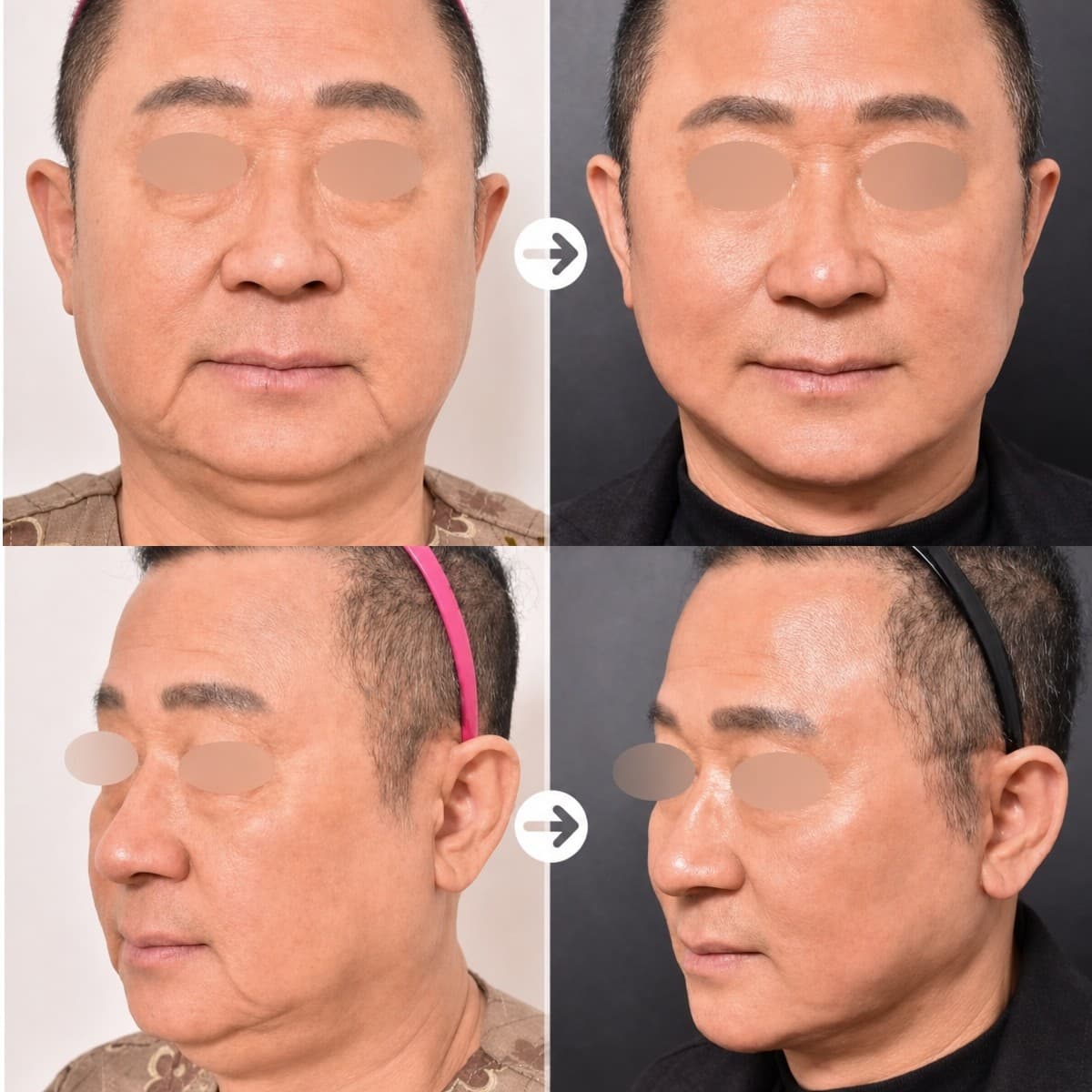 arm liposuction