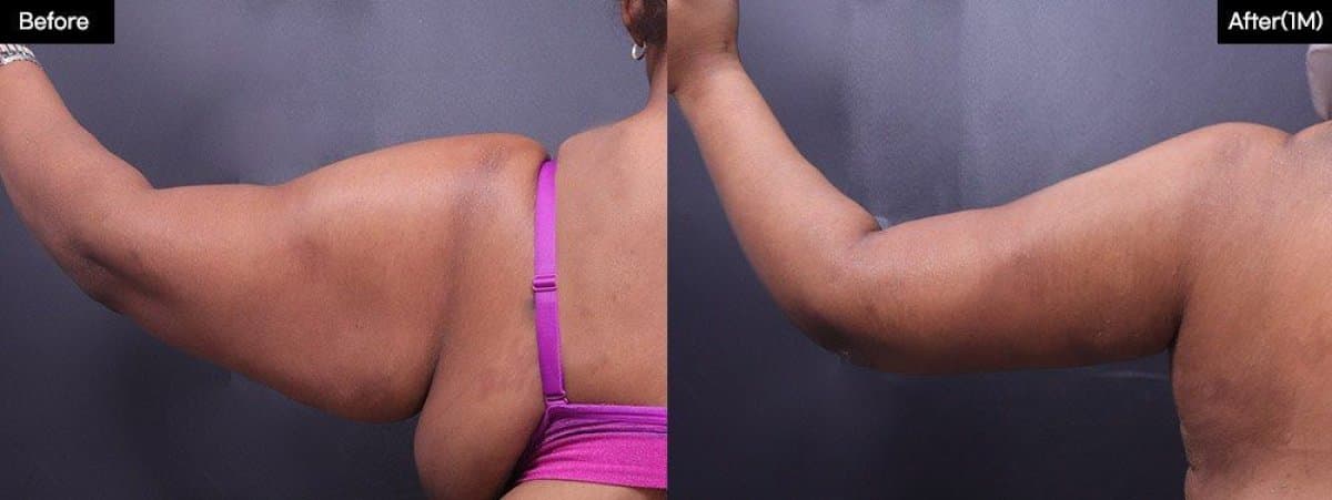 upper arm liposuction