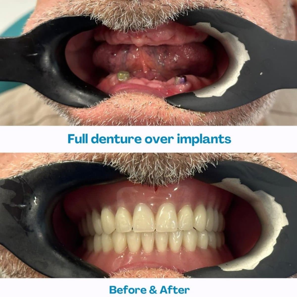 full dentures over implants