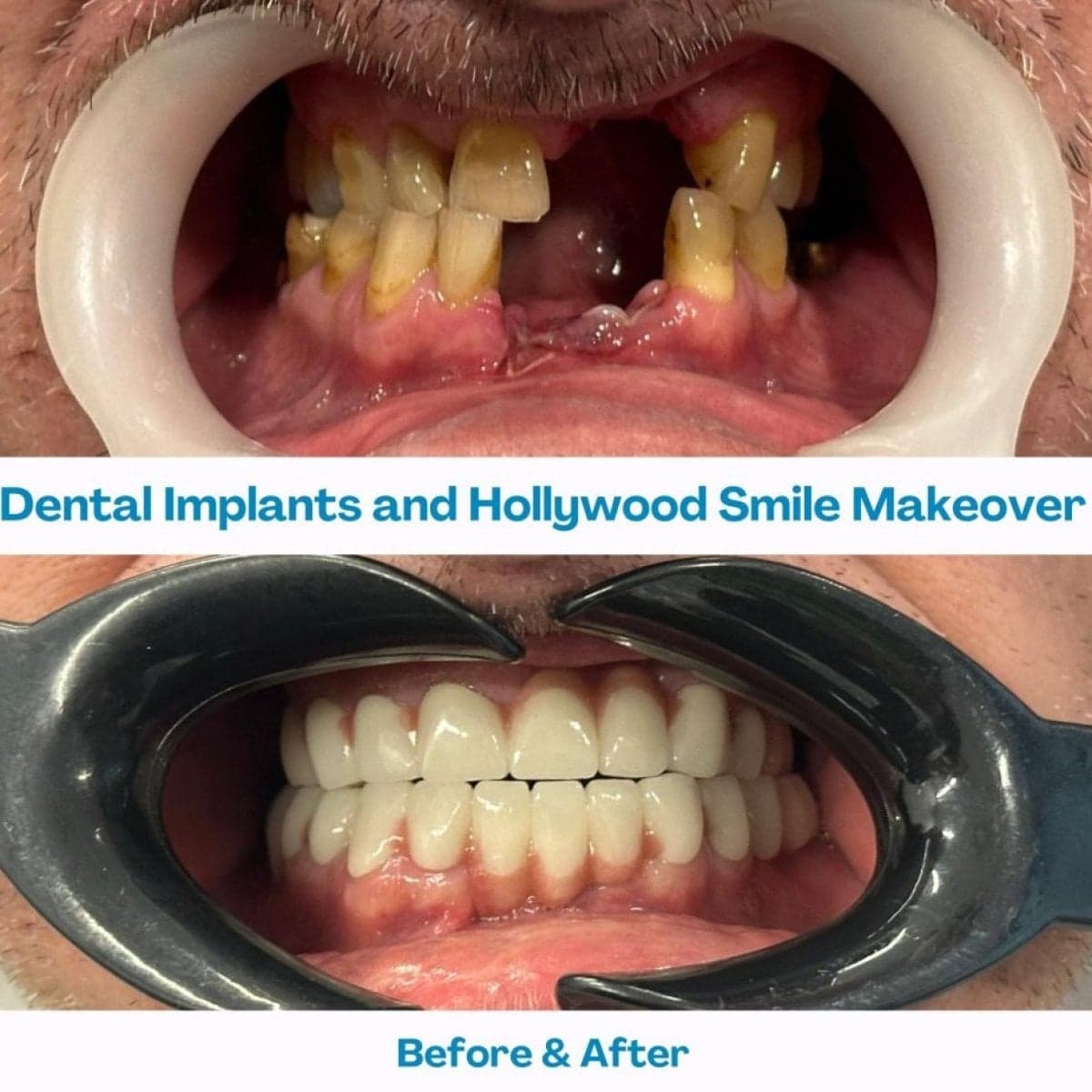 dental implants with Hollywood Smile makeover