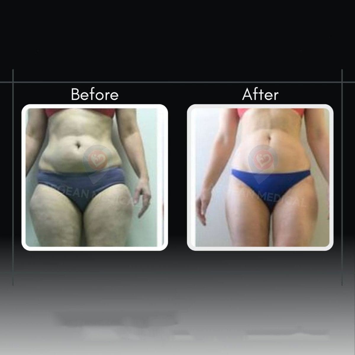 liposuction