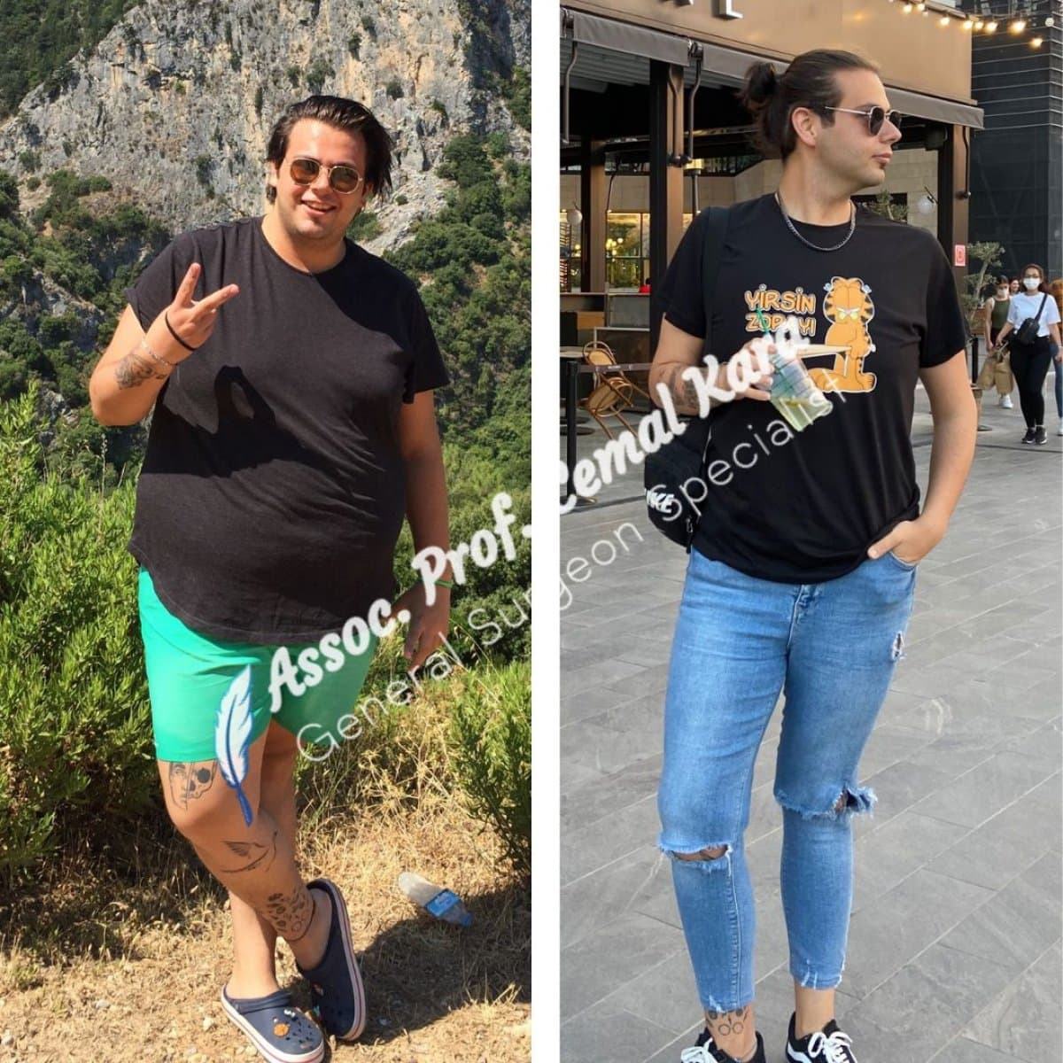 gastric sleeve