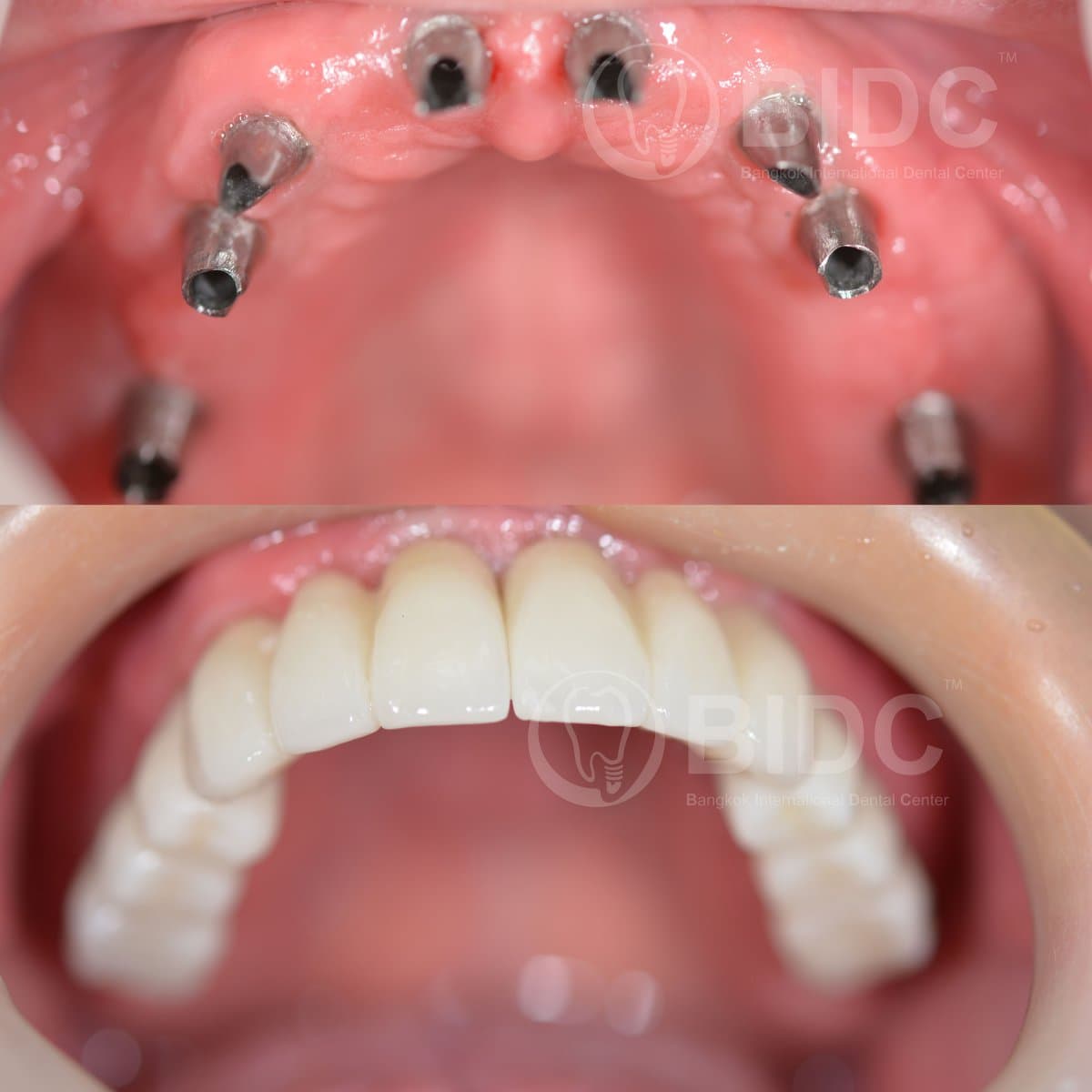 All-on-6 dental implants