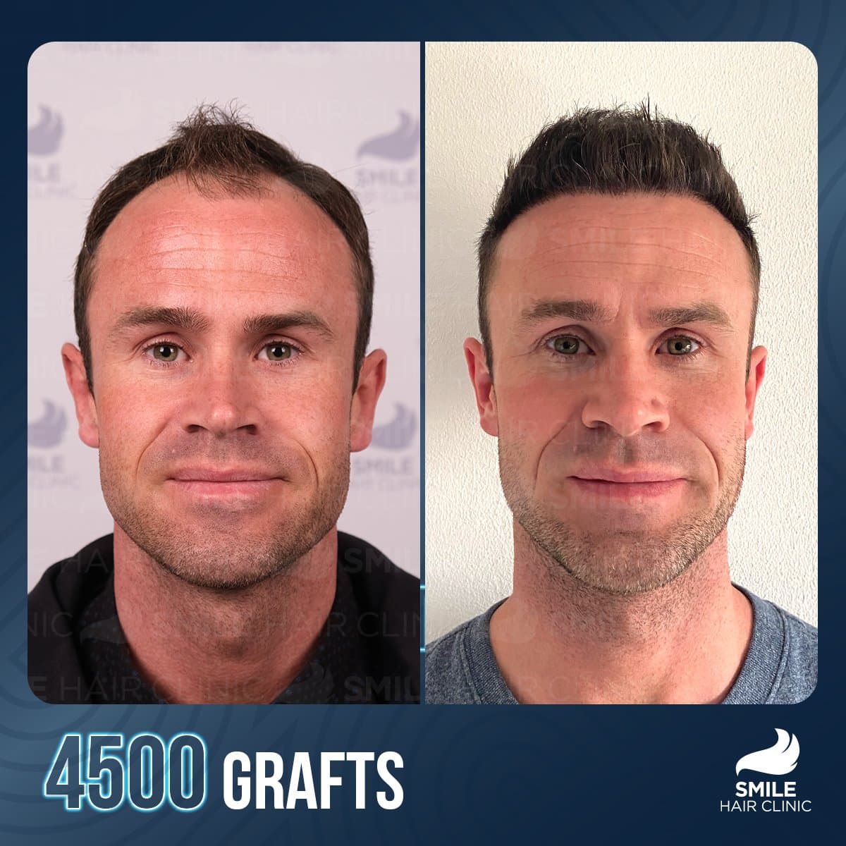 result, 4500 grafts