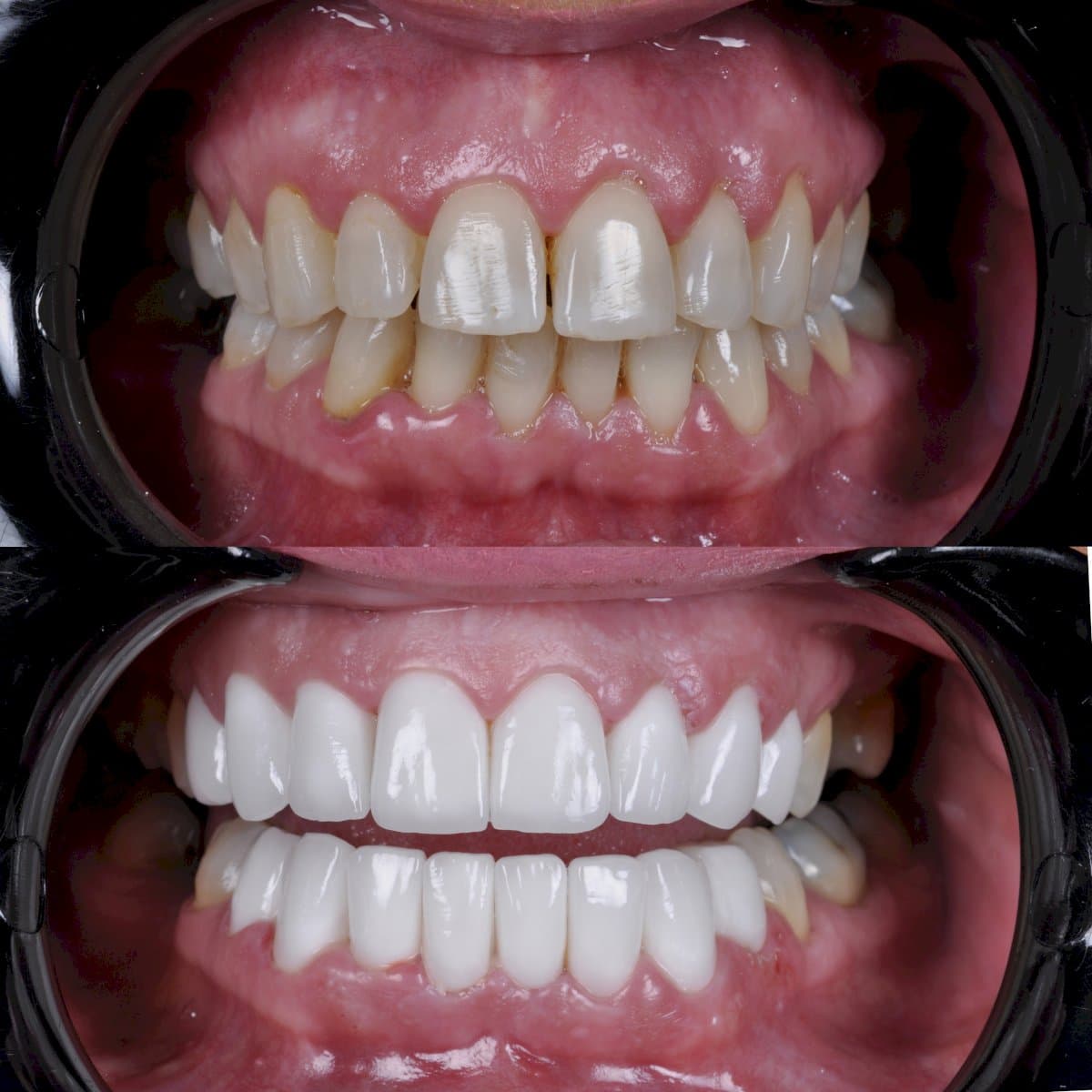porcelain veneer
