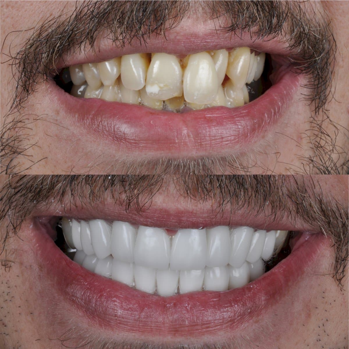 dental crown installation