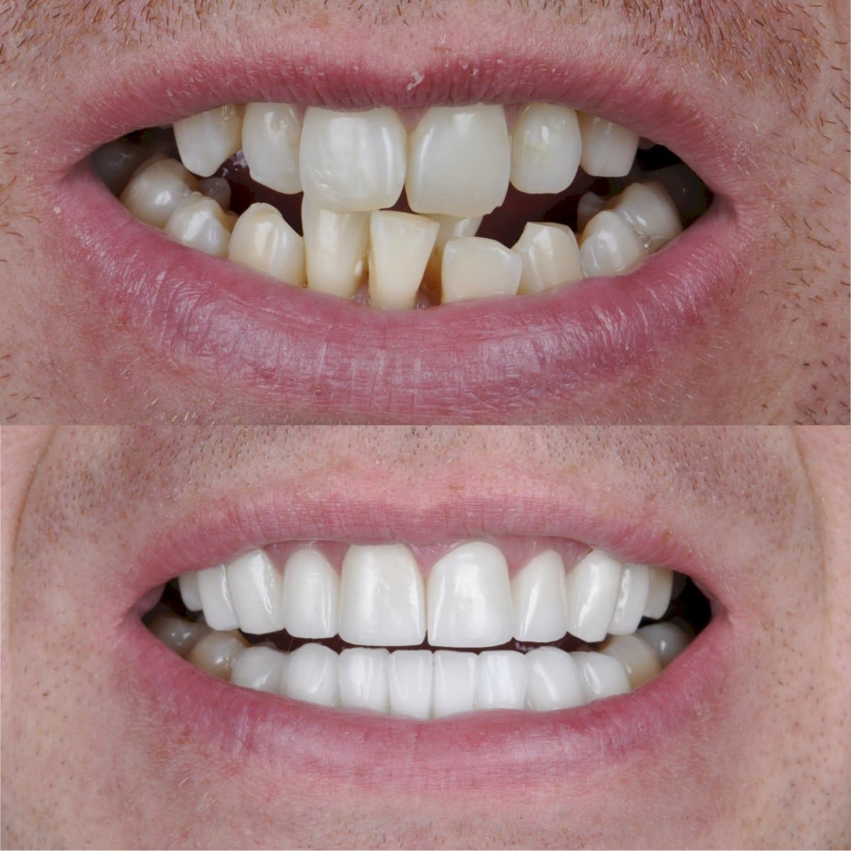 porcelain veneer