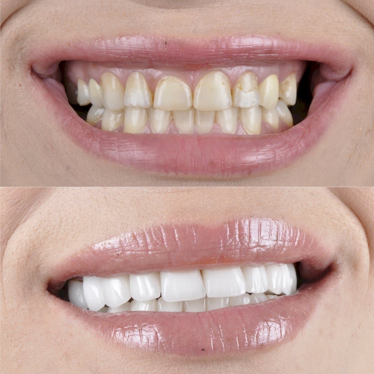 veneers