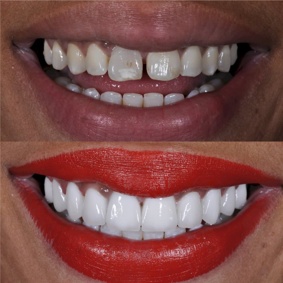 dental crown installation