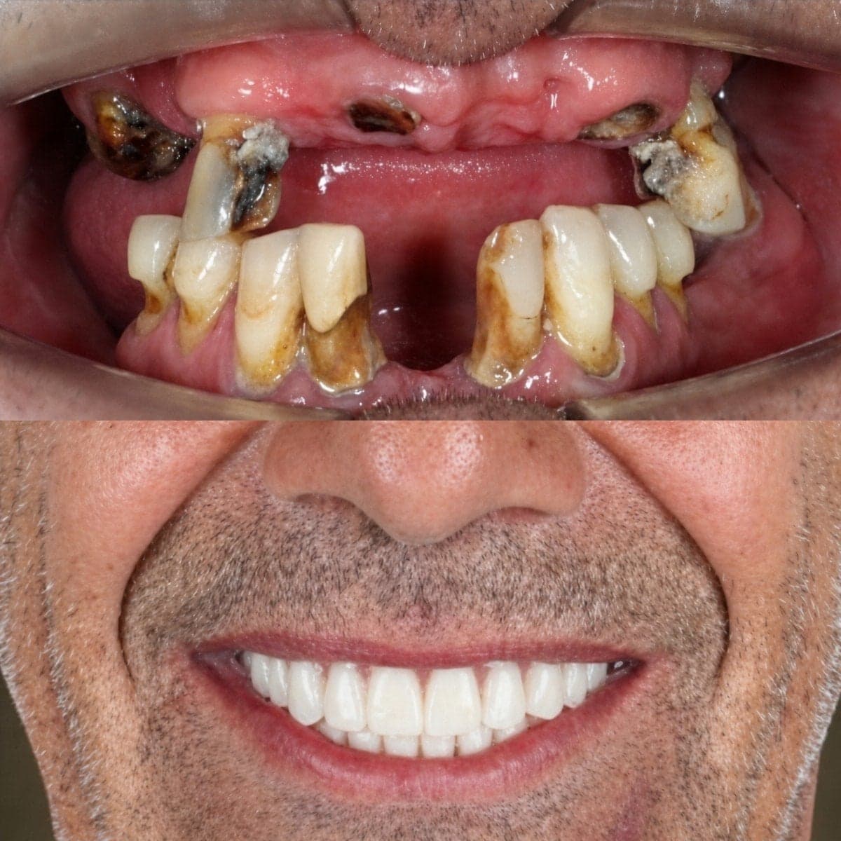 dental crown installation
