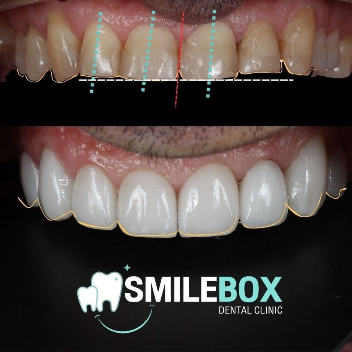 dental crown replacement