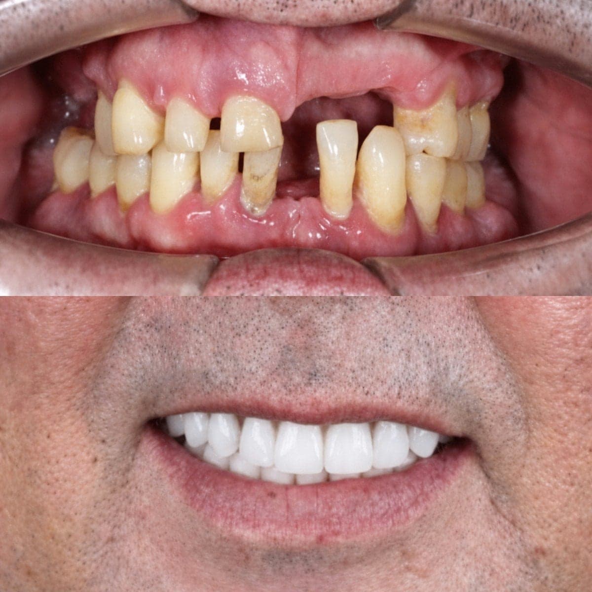 dental crown replacement