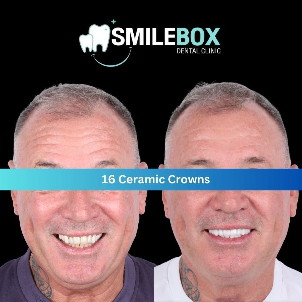 All-on-6 dental implants