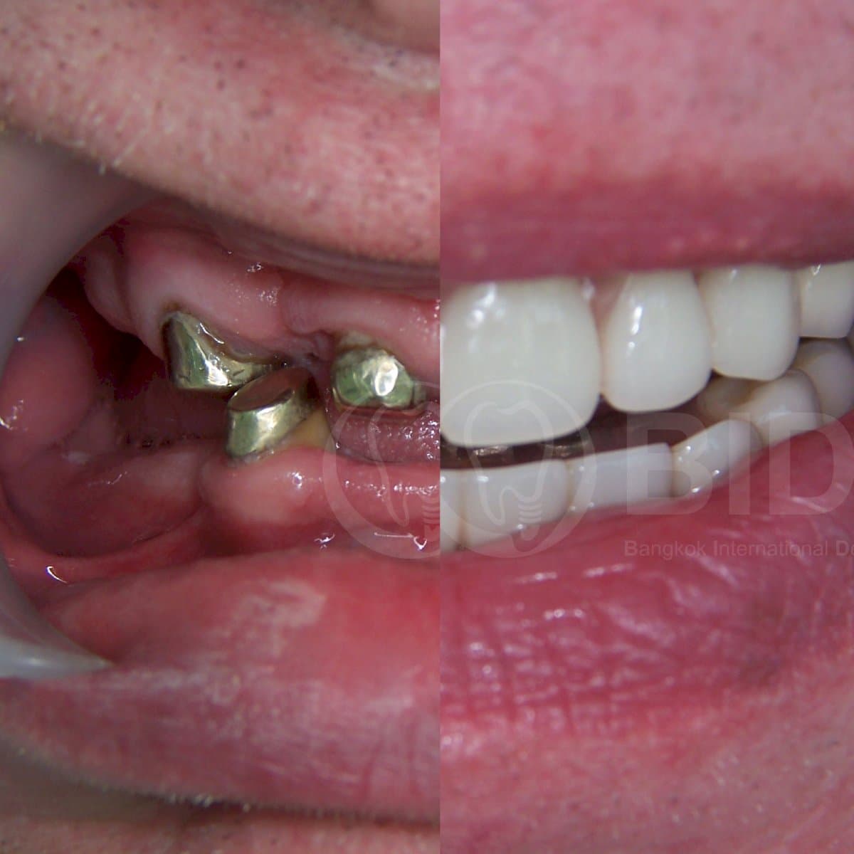 All-on-4 dental implants