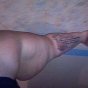 Panniculectomy