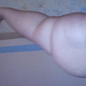 Panniculectomy