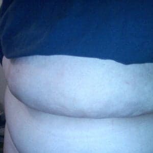 Panniculectomy