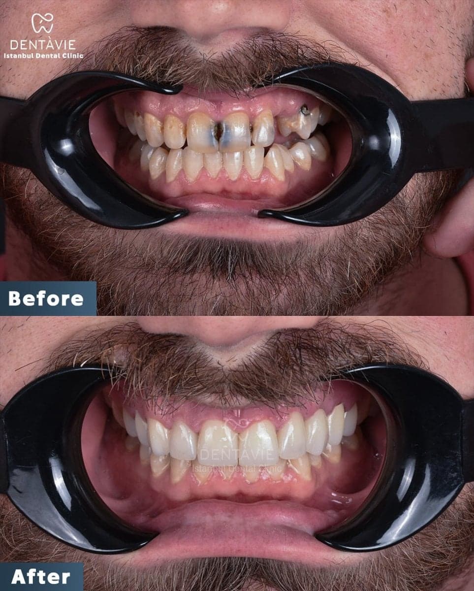 All-on-6 dental implants