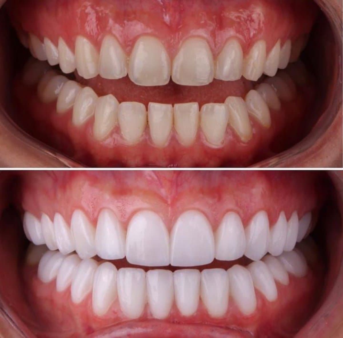 Hollywood Smile veneers